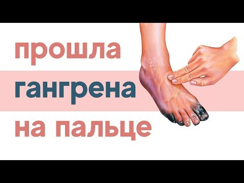 Видео: Гангренийг хэрхэн эмчлэх вэ: 9 алхам (зурагтай)