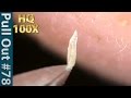 #78 Pull Out Blackheads Close up 100X - Blackheads Removal | ピンセットで角栓を抜くHQ100倍