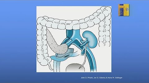 Current Status of Pancreas Versus Islet Transplantation