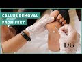 Callus removal from feet: balls of feet