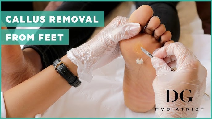 Satisfying hard skin on foot callus removal 