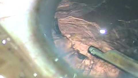 Phaco by Divide and Conquer technique for soft cataract - P Mohanta, 30/12/2016