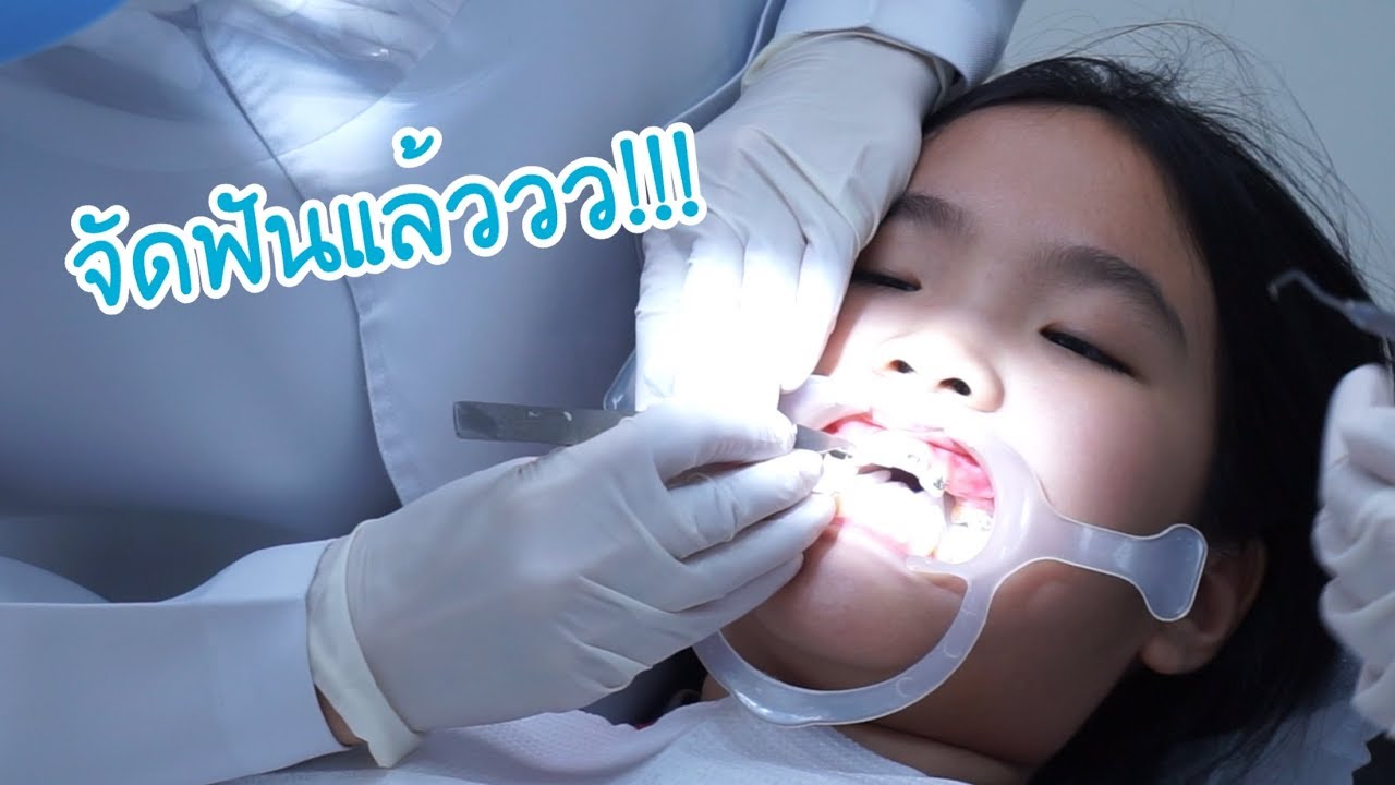 อัยจังจัดฟันแล้ววว | AiDesign