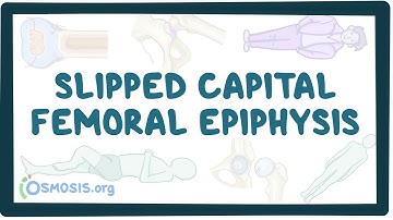 Slipped capital femoral epiphysis - an Osmosis Preview