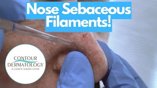 Nose Cheese Extractions!!!! | CONTOUR DERMATOLOGY