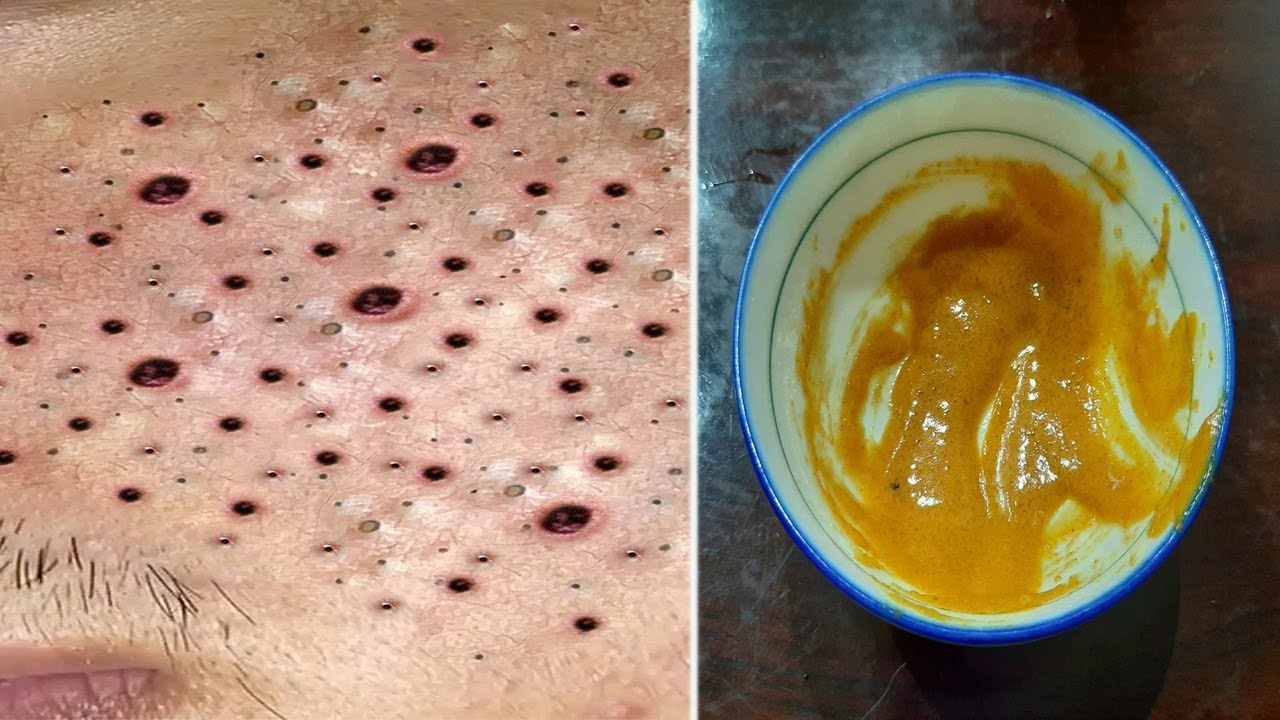 HOW TO REMOVE BLACKHEADS & WHITEHEADS from Nose & Face naturally at ...