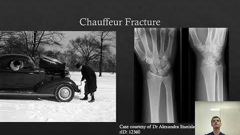Distal Radius Fracture by Dr Max Whitchurch