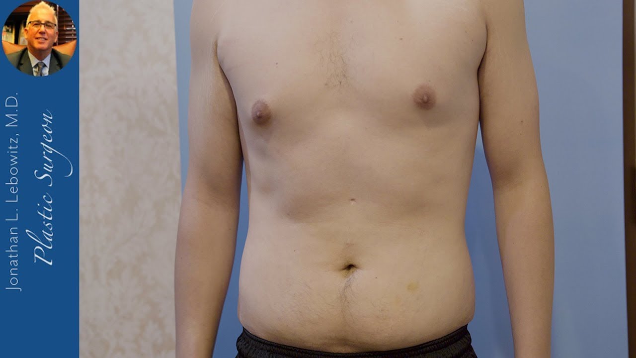 How to tell if you have gynecomastia or fat