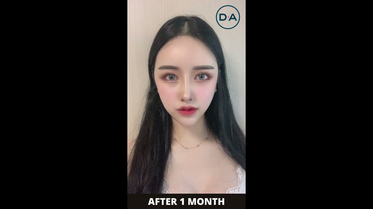 Plastic Surgery in Korea Beautiful Transformation Process Only at DA  shorts