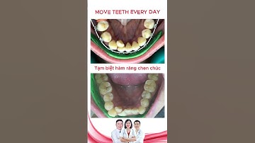 Niềng răng chen chúc, khấp khểnh | Bác sĩ Thu Gia Lâm