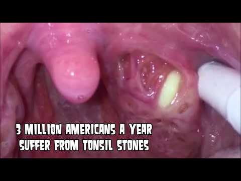 Extreme Tonsil Stone Removal