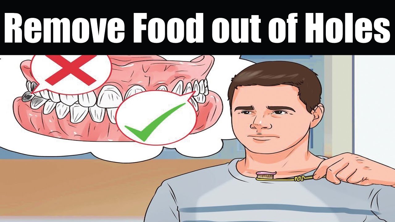 How To Remove Food Out Of Holes From Extracted Wisdom Teeth