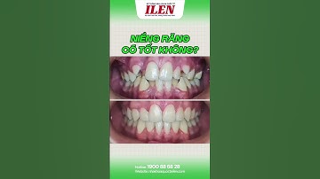 Niềng răng có tốt không❓Cùng xem hết video để có câu trả lời nhé❗ #nhakhoaquocteilen #niengrang