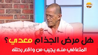 هل مرض الجذام معدي؟  المتعافي منه يجيب من واقع رحلته