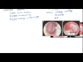 Acute Otitis Media and Otitis Media with Effusion for USMLE Step 2