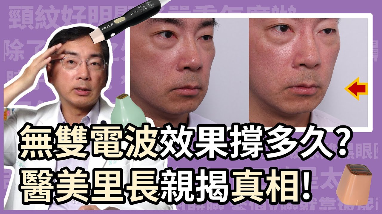 無雙電波 Density 效果可以撐多久？皮膚科林政賢醫師親測告訴你真相！