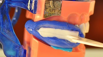 The triple tray impression technique : A clinical guide