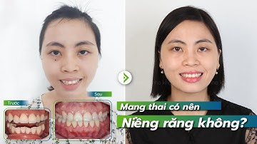 Quá trình tháo mắc cài sau hơn 2 năm Niềng răng - 9630 rồi cũng thành đều tăm tắp