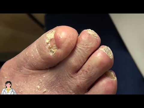 Gilmore Fans: New Dr Nail Nipper Channel - Toenail Fungus And More!