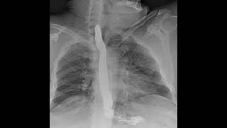 Dynamic Digital Radiology Retrospective View Of Esophagus Esophagogastroduodenoscopy Segd Part 2