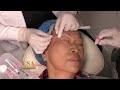 Nonsurgical periorbital rejuvenation on a 77year old female