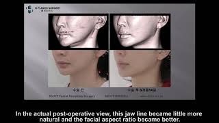 Postscript of a Square Jaw Reconstruction Surgery [H plastic surgery]