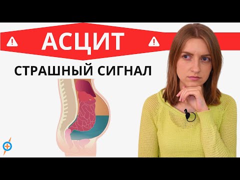 Какие болезни ведут к АСЦИТУ (водянке живота)? | Mednavigator.ru