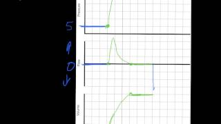 Ventilator Mode & Waveforms Review