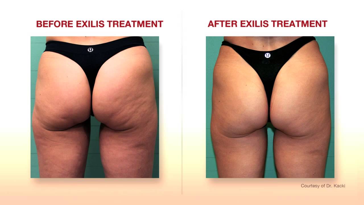 Reducing Cellulite with Exilis Ultra 360: Exploring the Benefits of  Advanced Technology - Apex Medical Center