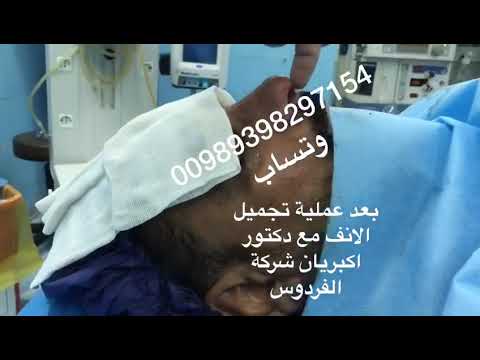 بعد عملية تجميل الانف نتائج ممتازه مع الدكتور محمد اكبريان عملية تجميل الانف ايران مشهد محمد اكبريان