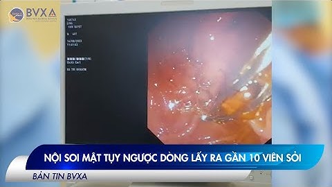 TIN NÓNG | NỘI SOI MẬT TỤY NGƯỢC DÒNG LẤY RA GẦN 10 VIÊN SỎI ĐƯỜNG MẬT MÀ KHÔNG CẦN PHẪU THUẬT
