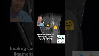 Rehab alone Healing ACL no surgery Case Study 26th October 2025