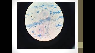 tuberculosis (case study)