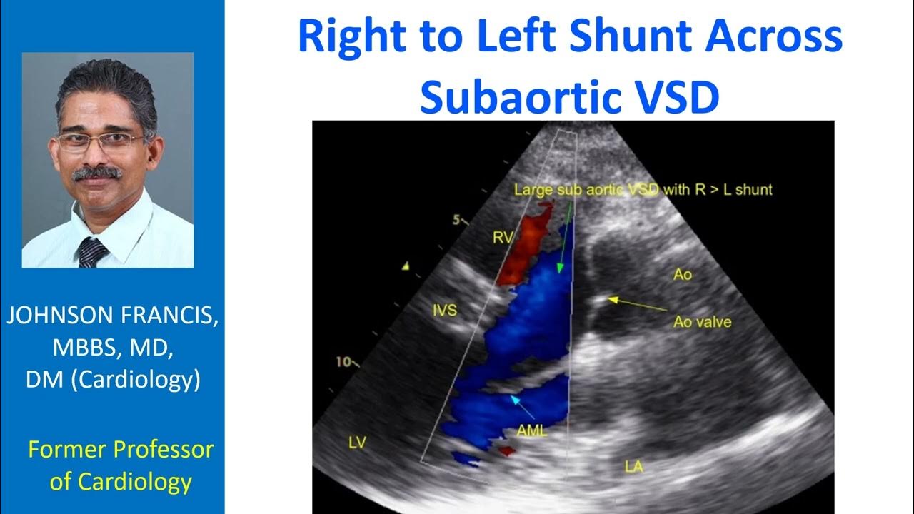 Right to left shunt across subaortic VSD YouTube