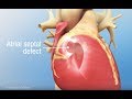 Understanding Atrioventricular (AV) Septal Defect