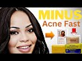 Minus Acne Skin lightening Soaps In Jamaica || Great for Hyperpigmentation In Christmas/Newyear 2023