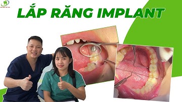 Lắp Răng Hàm Lớn Trên Chân Răng Nhân Tạo Implant - Ăn Nhai Thoải Mái