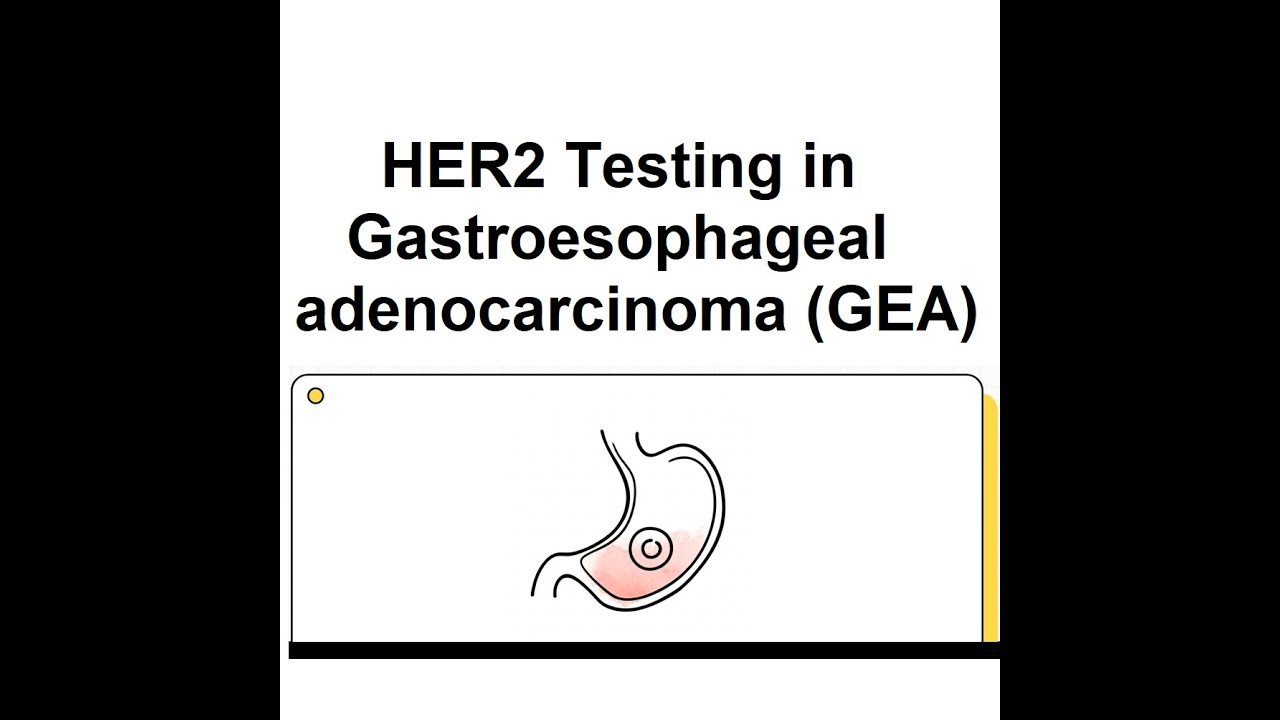 Pathologist's Guide for HER2 Testing in Gastroesophageal adenocarcinoma (GEA)