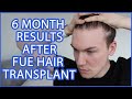 FUE Hair Transplant | Month 6 | FULL RECAP Surgery, Growth, Before & After, Advice | Progress Update