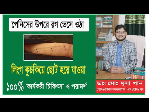 ভিডিও: একটি রিংয়ের নীচে ত্বকের ফুসকুড়ি নিরাময়ের 3 উপায়