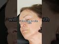 Do your patients ask for an Angelina Jolie jawline?
