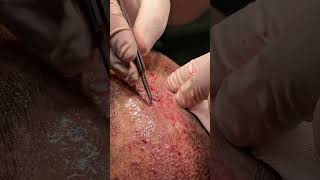 #hair #hairtransplant #haare #haartransplantation #haircare