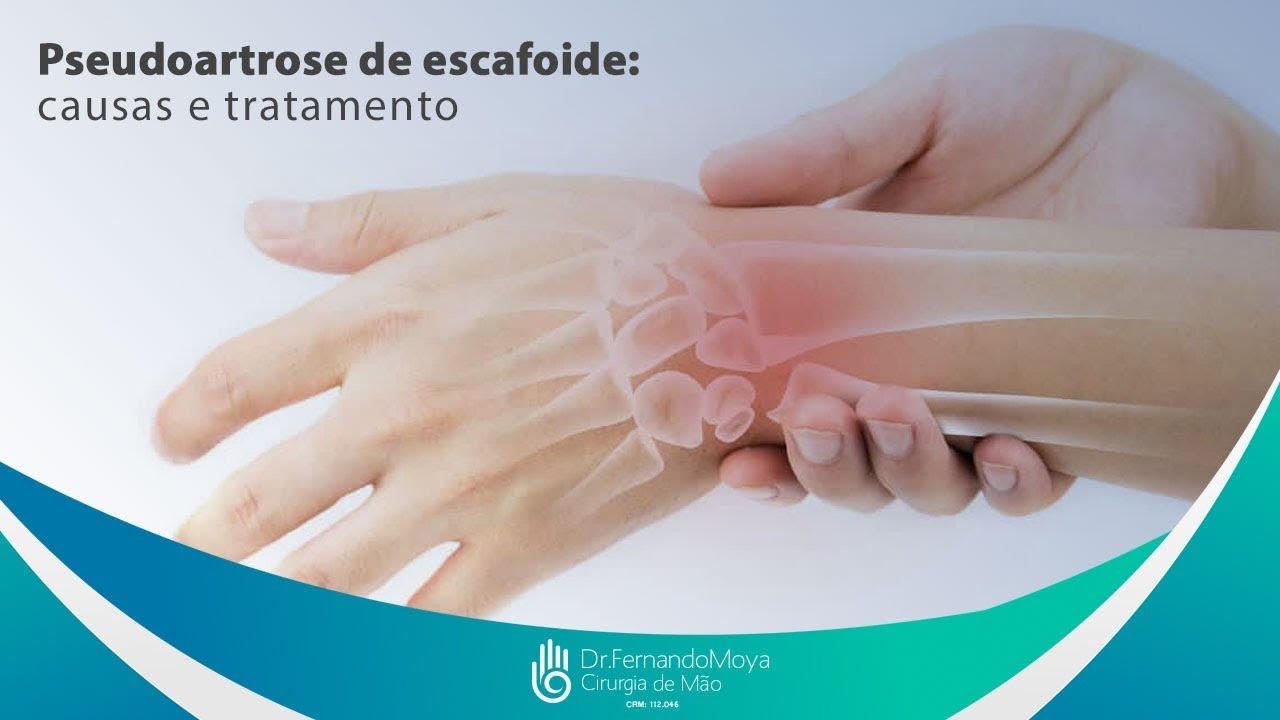Pseudoartrose de escafoide: causas e tratamento | Dr. Fernando Moya CRM ...
