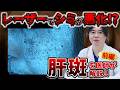 【シミ】レーザー治療で悪化！？肝斑について医師が徹底解説【前編】