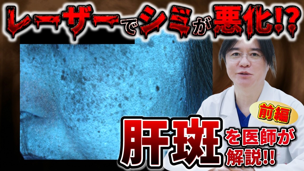 【シミ】レーザー治療で悪化！？肝斑について医師が徹底解説【前編】