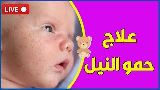 حمو النيل عند الاطفال والرضع وحديثي الولادة وعلاجه والفرق بينه وبين الحساسية