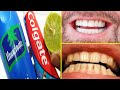 Teeth whitening using toothpaste | Teeth whitening home remedies | Simple toothpaste tricks &amp; Hacks