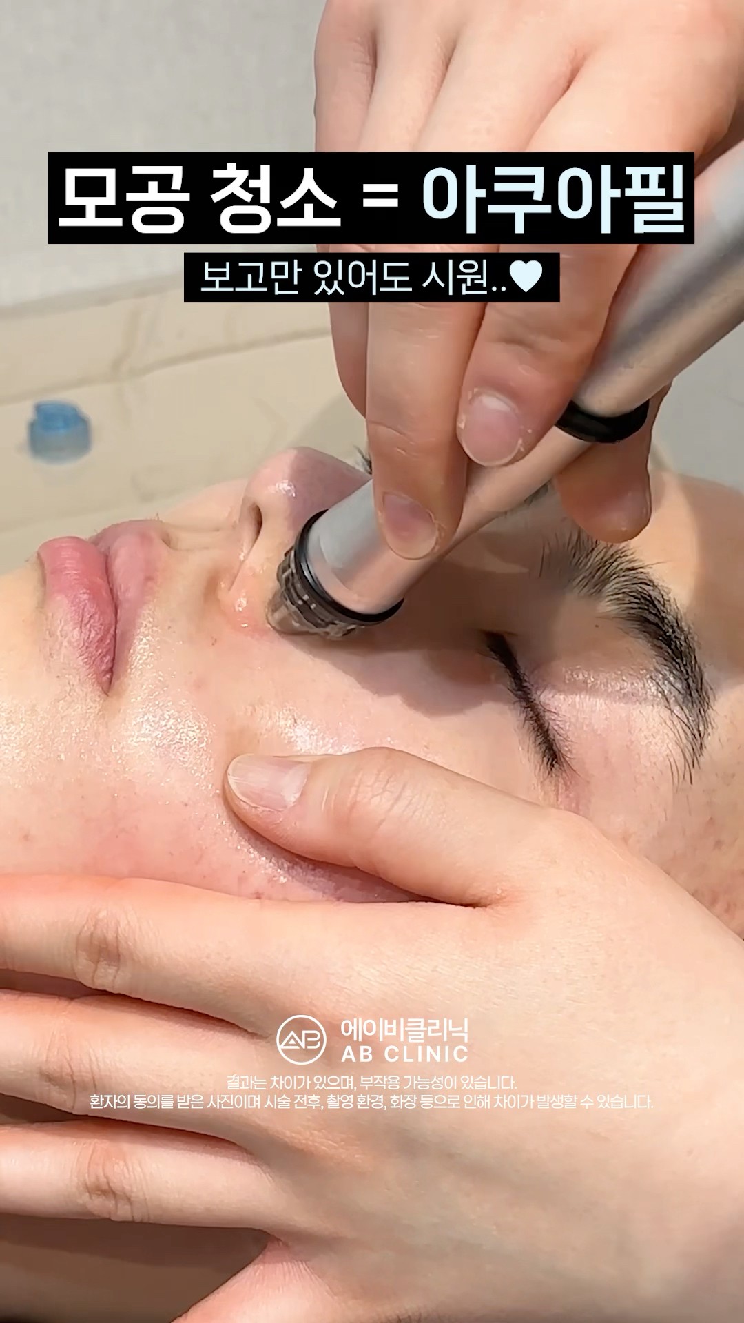화장품으론 못하는 모공 딥 클린 시술🫧