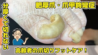 分厚く肥厚して切れなくなった爪のケア【相模原･町田巻き爪矯正センター】