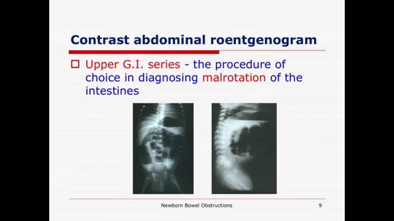 Bowel obstruction Bowel obstruction in Newborn Intestinal obstruction